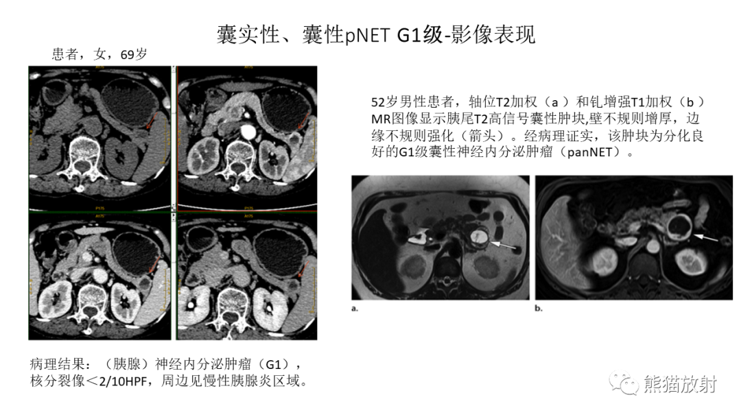 【病例】胰腺神经内分泌肿瘤2例CT及MR影像-25