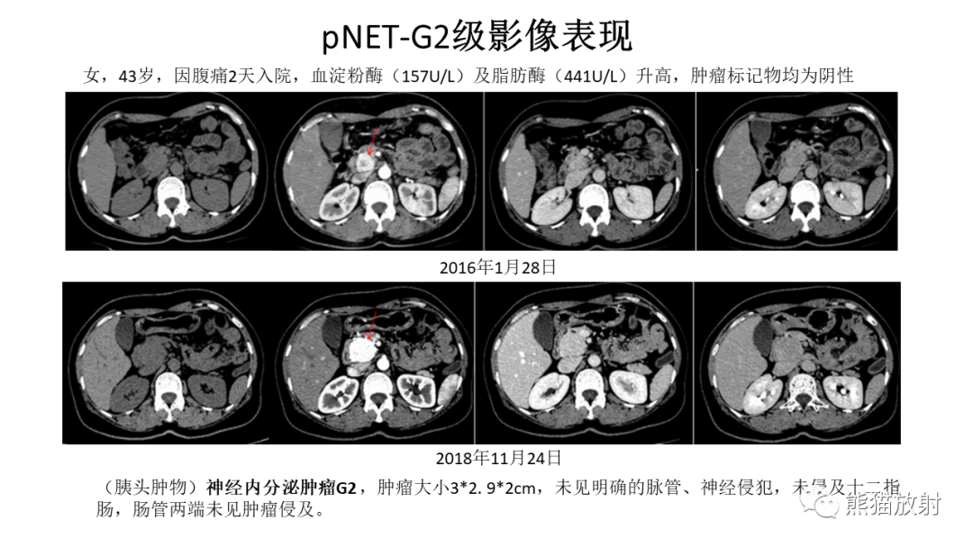 【病例】胰腺神经内分泌肿瘤2例CT及MR影像-27