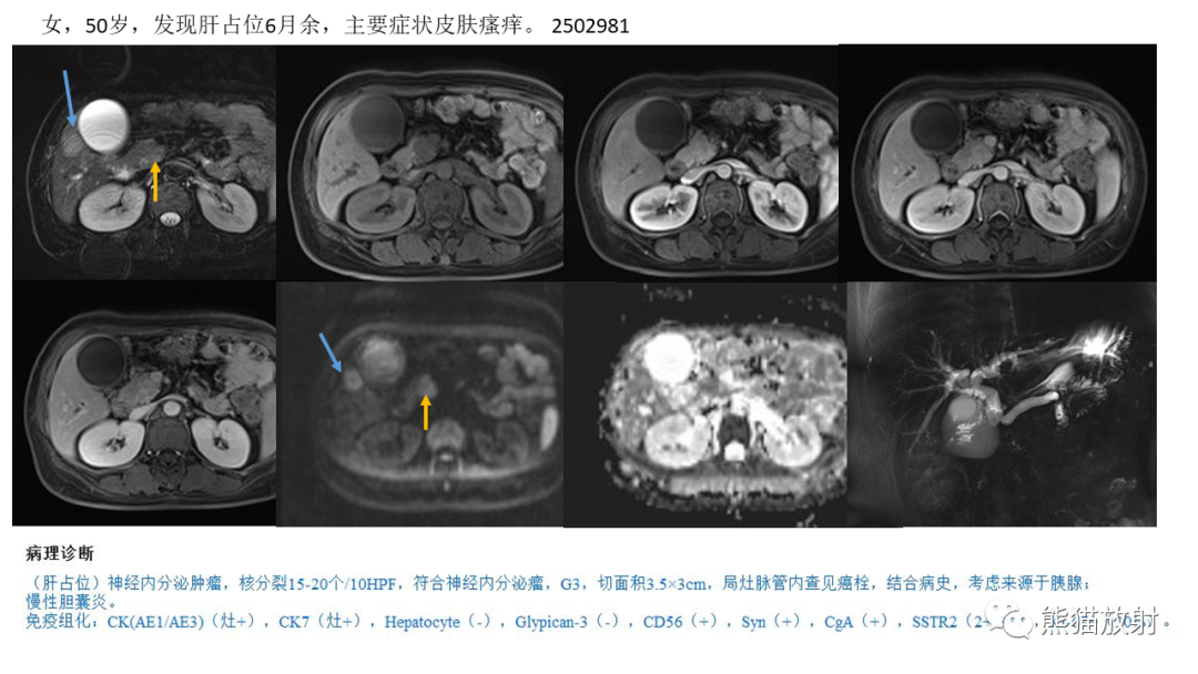 【病例】胰腺神经内分泌肿瘤2例CT及MR影像-29