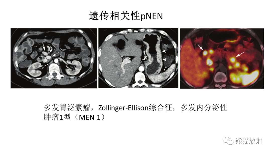 【病例】胰腺神经内分泌肿瘤2例CT及MR影像-30