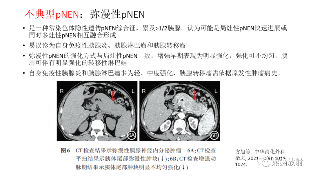【病例】胰腺神经内分泌肿瘤2例CT及MR影像-31