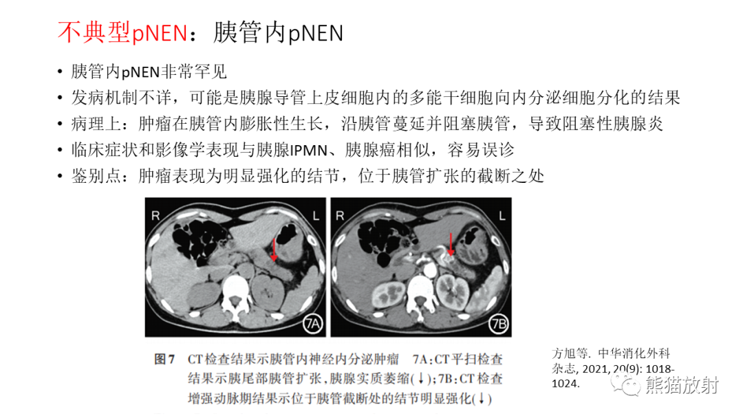 【病例】胰腺神经内分泌肿瘤2例CT及MR影像-32