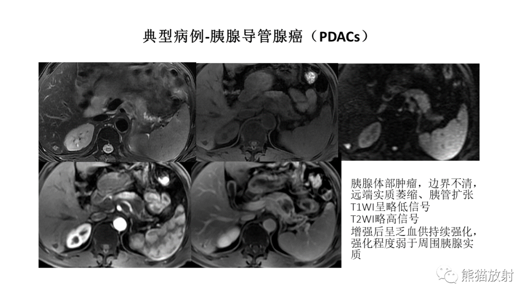 【病例】胰腺神经内分泌肿瘤2例CT及MR影像-35