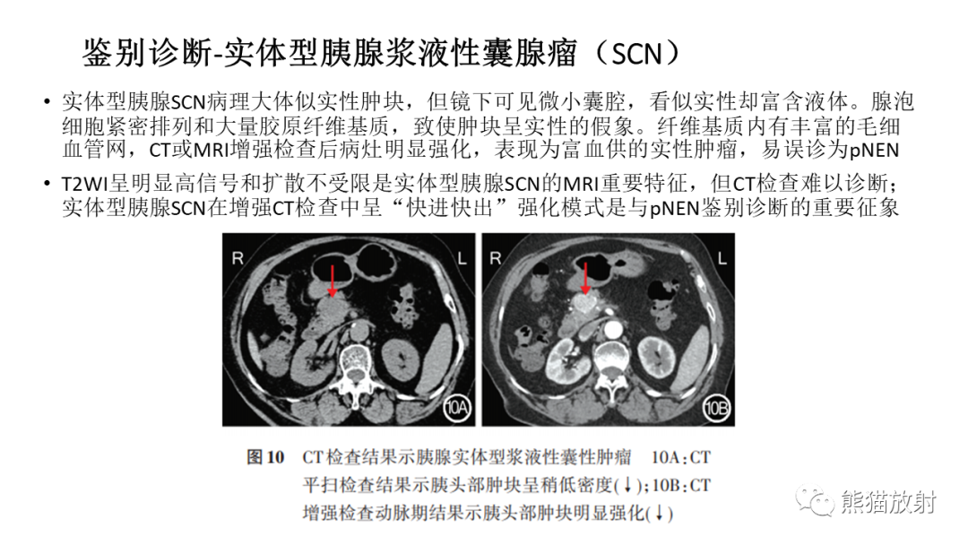 【病例】胰腺神经内分泌肿瘤2例CT及MR影像-36
