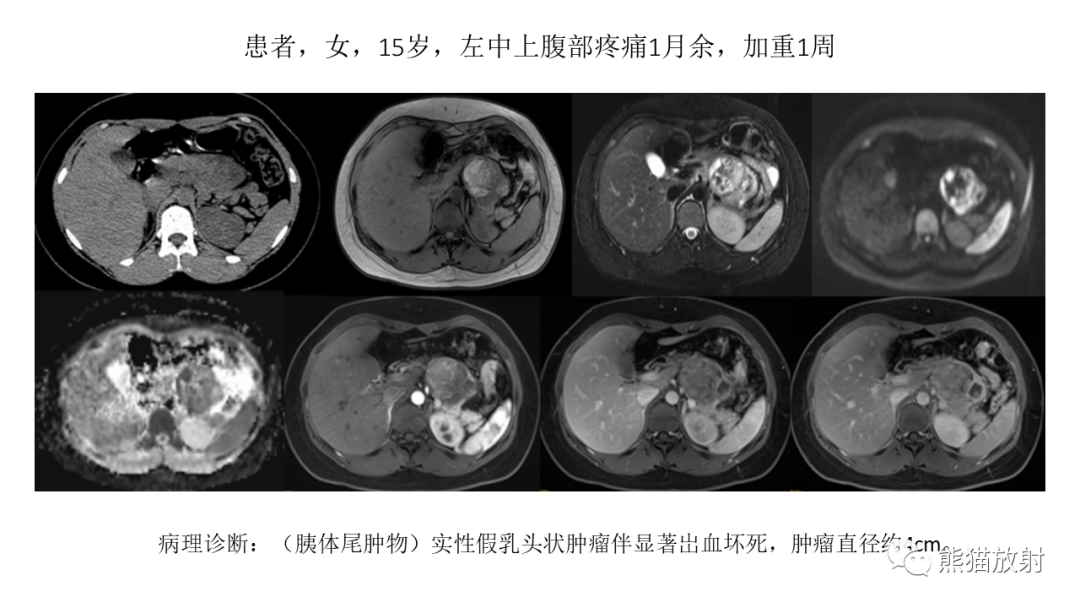 【病例】胰腺神经内分泌肿瘤2例CT及MR影像-38