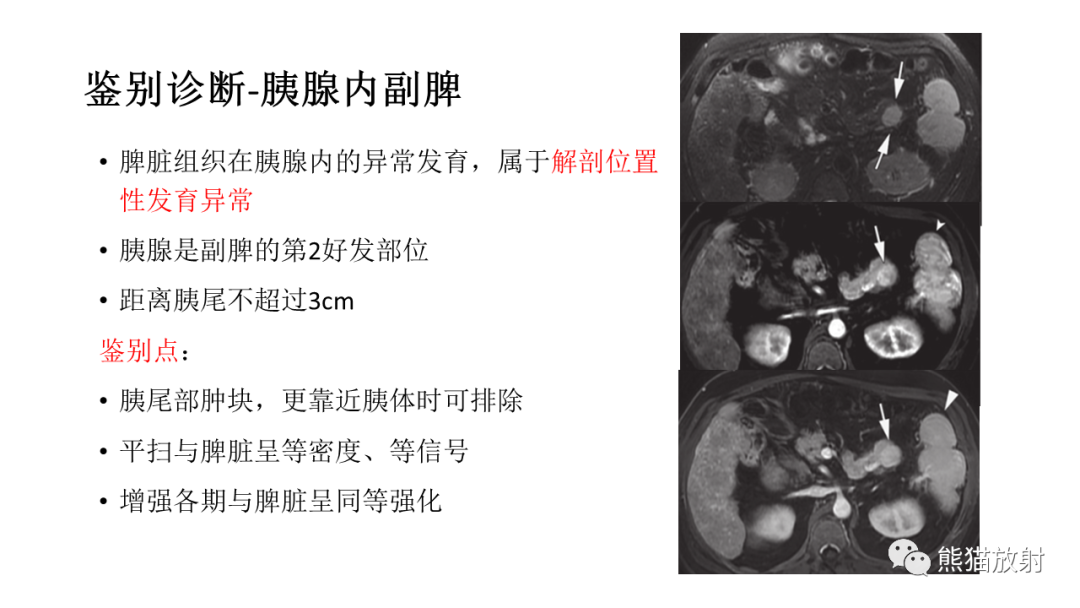 【病例】胰腺神经内分泌肿瘤2例CT及MR影像-39