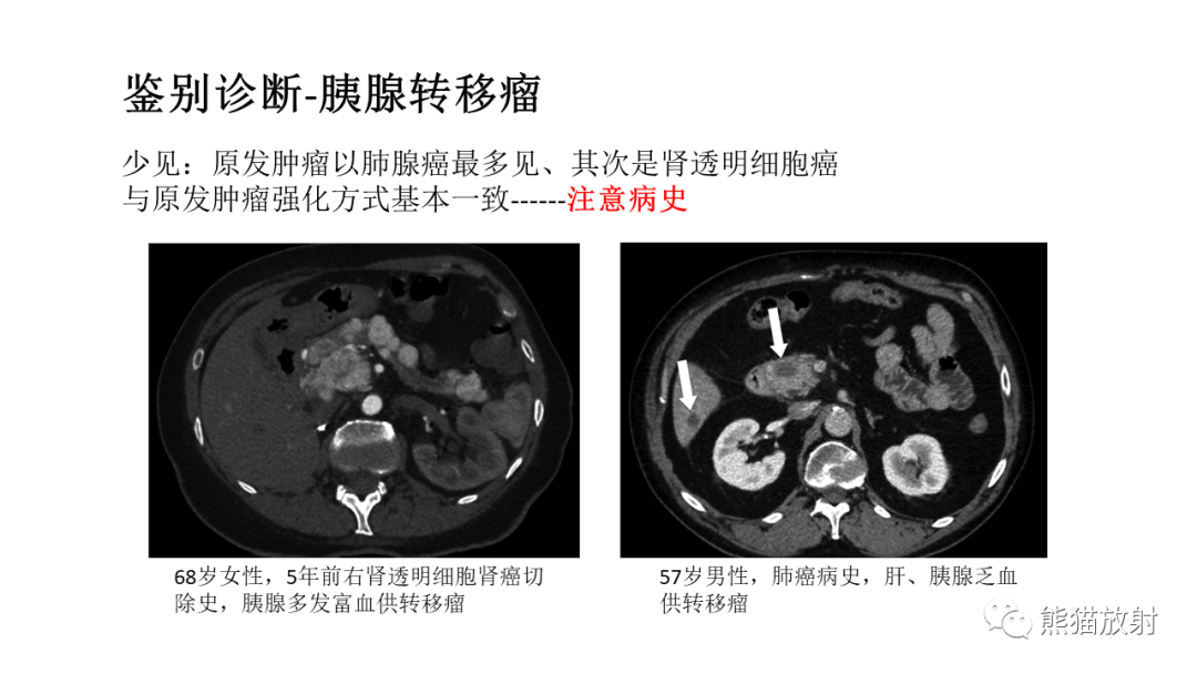 【病例】胰腺神经内分泌肿瘤2例CT及MR影像-40