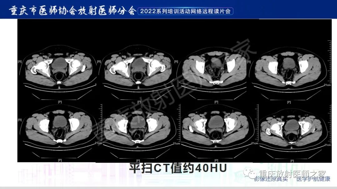 【病例】腺性膀胱炎1例CT影像-3