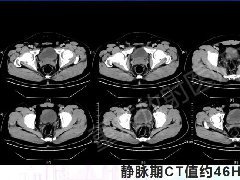 腺性膀胱炎1例CT影像