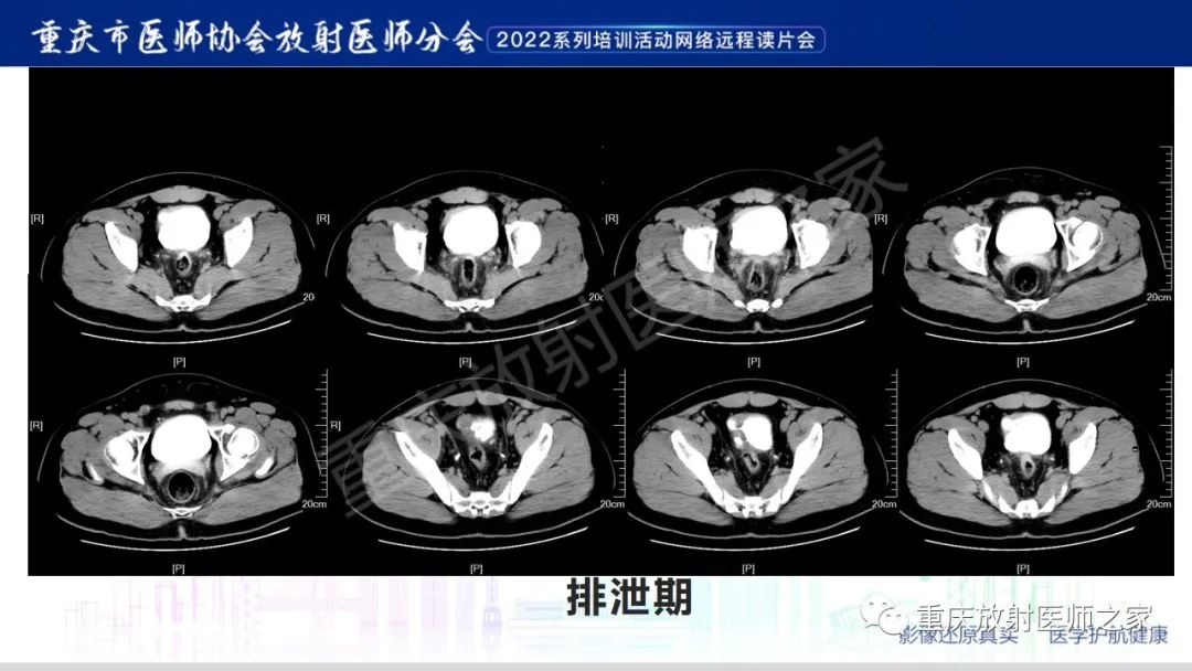 【病例】腺性膀胱炎1例CT影像-6