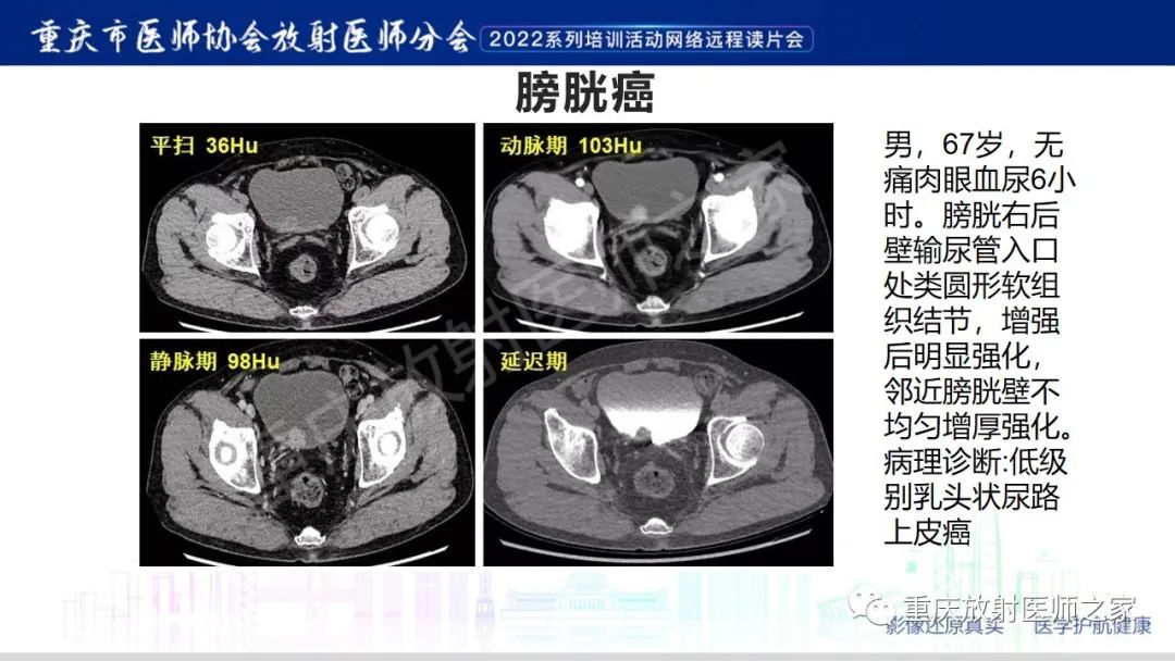 【病例】腺性膀胱炎1例CT影像-25