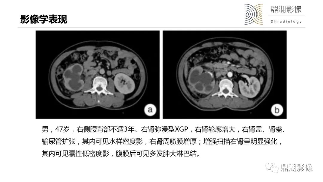 【PPT】黄色肉芽肿性肾盂肾炎-15