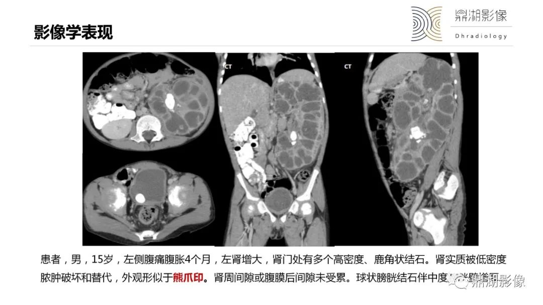 【PPT】黄色肉芽肿性肾盂肾炎-16