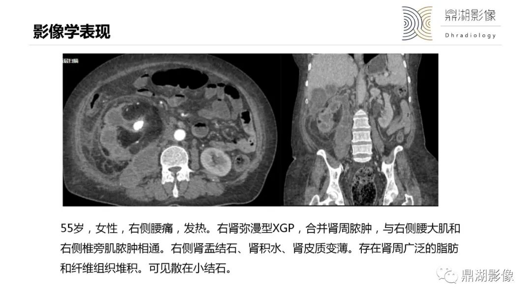 【PPT】黄色肉芽肿性肾盂肾炎-22
