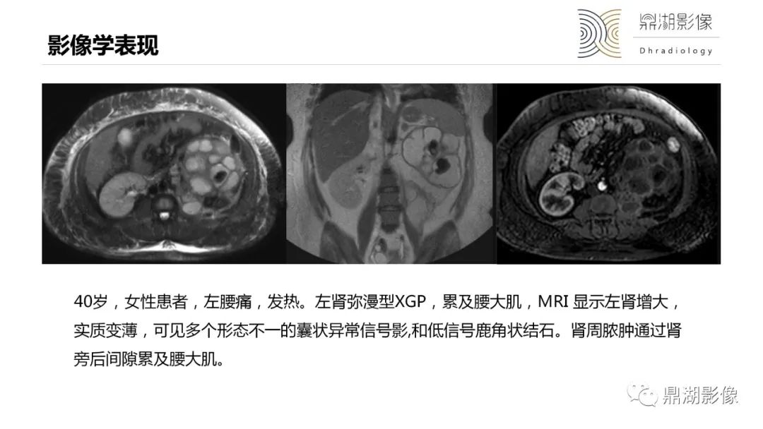 【PPT】黄色肉芽肿性肾盂肾炎-27