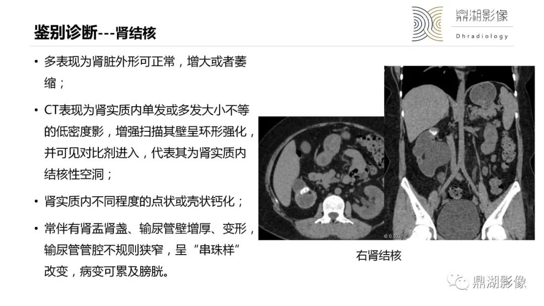 【PPT】黄色肉芽肿性肾盂肾炎-29
