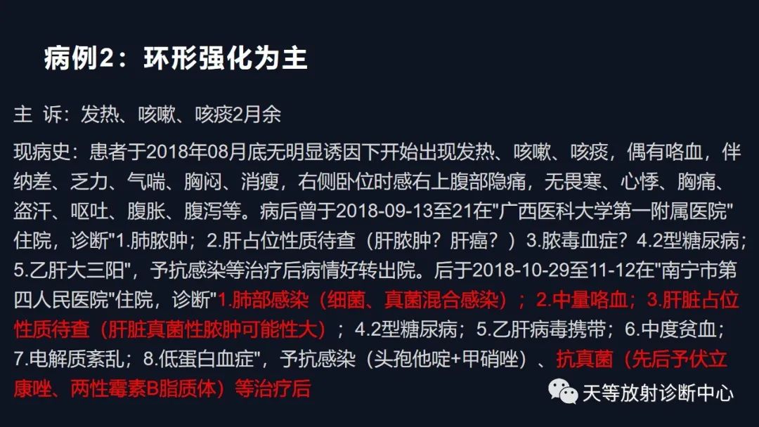 【病例】肝脓肿1例CT影像-21