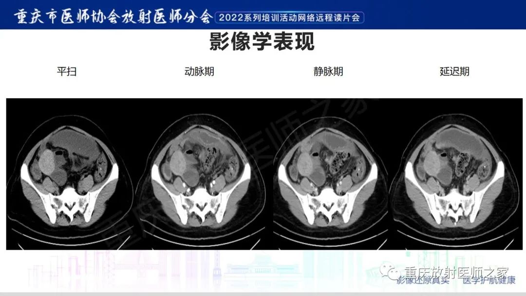 【病例】腹腔纱布异物(纱布瘤)一例CT影像-4