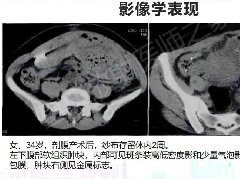 腹腔纱布异物(纱布瘤)一例CT影像