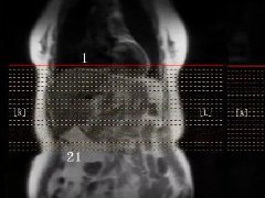 上腹部+MRCP该如何扫描
