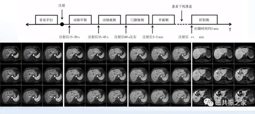 上腹部+MRCP该如何扫描-14