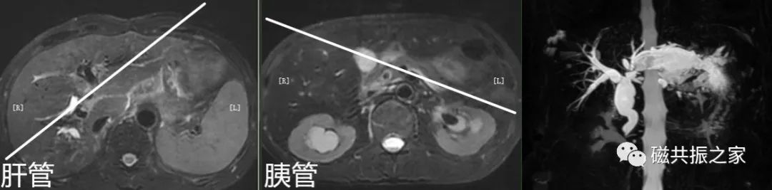 上腹部+MRCP该如何扫描-19