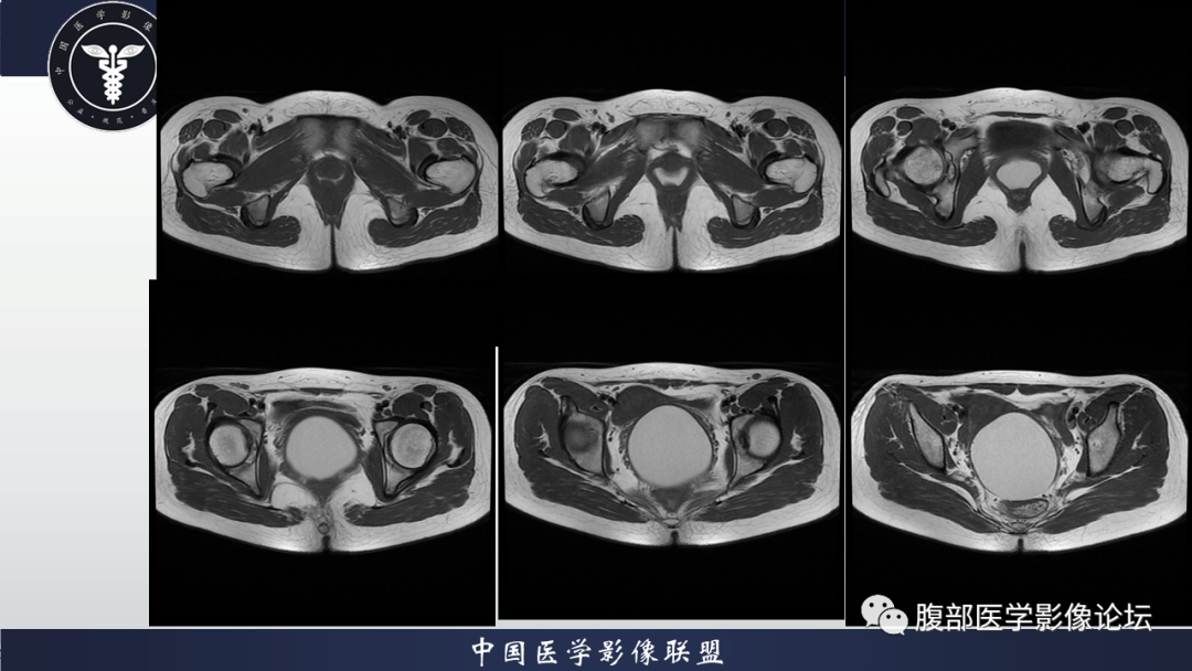 【病例】先天性阴道闭锁1例MR影像-3