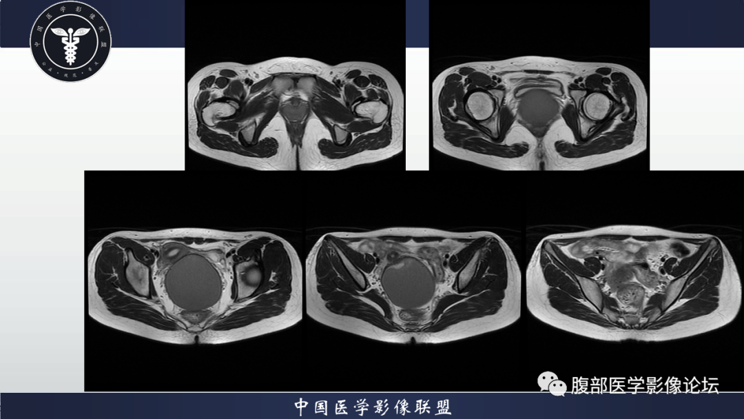 【病例】先天性阴道闭锁1例MR影像-6