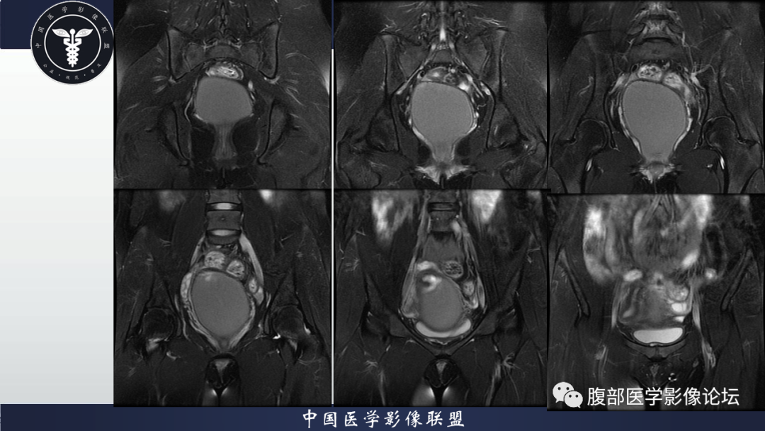 【病例】先天性阴道闭锁1例MR影像-7
