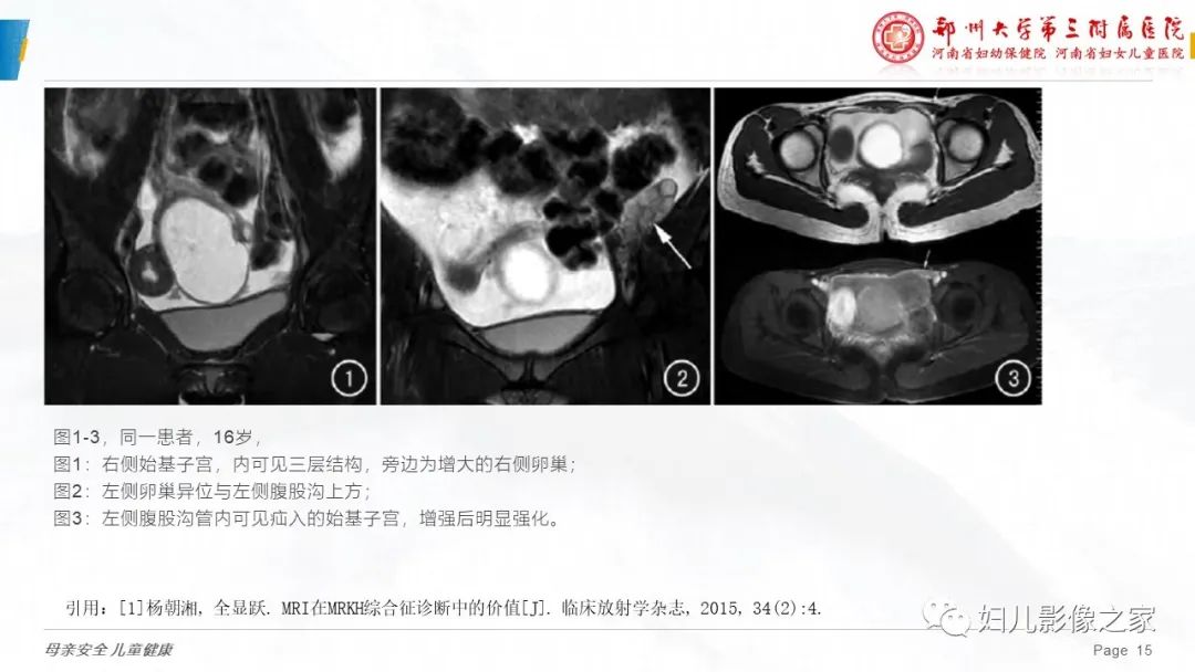 【病例】先天性阴道闭锁1例MR影像-26