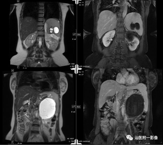 【病例】胰腺真性囊肿 VS 假性囊肿-23