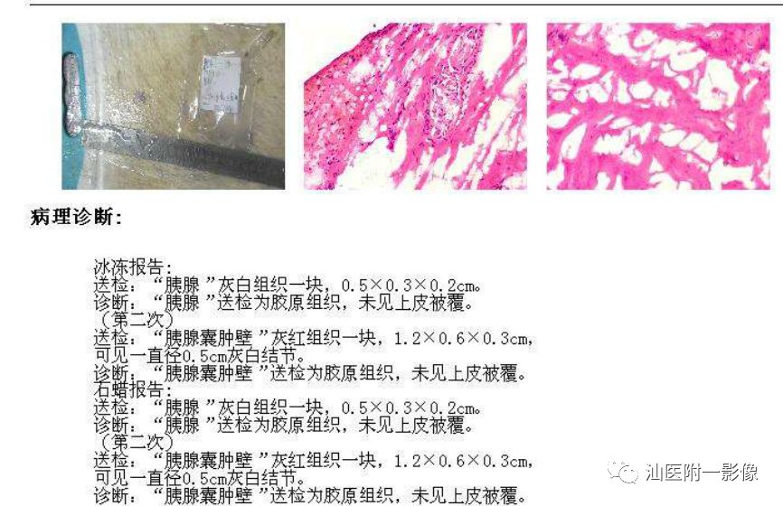 【病例】胰腺真性囊肿 VS 假性囊肿-28