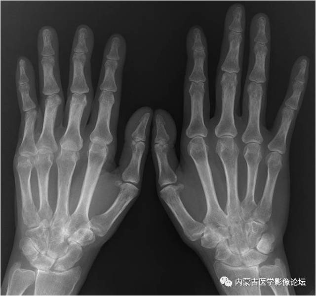 手X线的正常表现、常见变异及病变鉴别