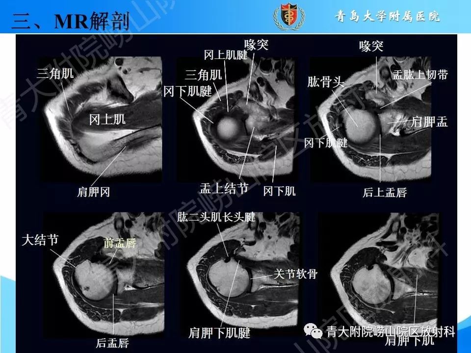 【PPT】肩关节运动损伤的MRI诊断