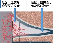 半月板解剖分区和损伤分类