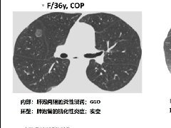 <b>肺部反晕征影像诊断思维</b>