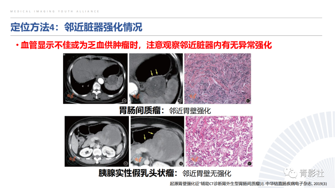【PPT】左上腹肿块定位诊断思路-35