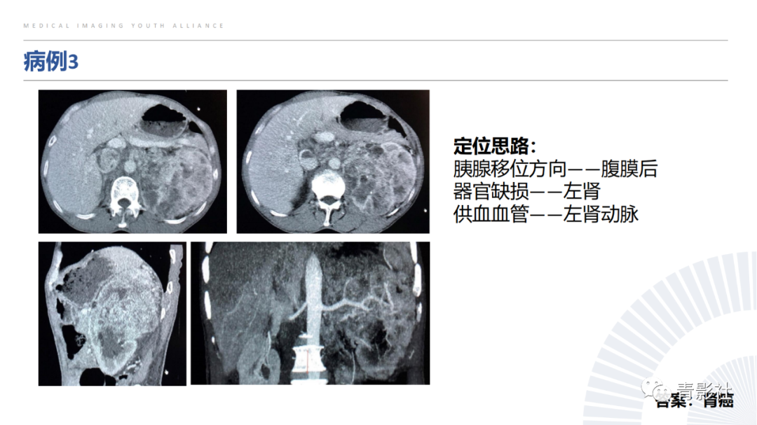 【PPT】左上腹肿块定位诊断思路-47