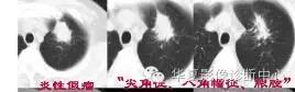 磨玻璃结节良恶性影像分析策略