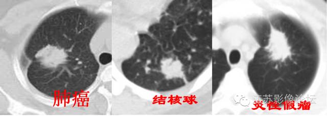 肺部结节的CT鉴别特征 肺部结节的CT鉴别特征