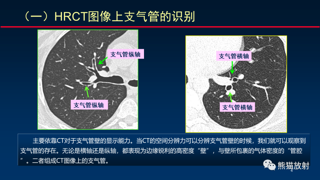 【PPT】HRCT对肺结核细节的观察进展-4