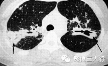 肺内片状阴影的鉴别诊断