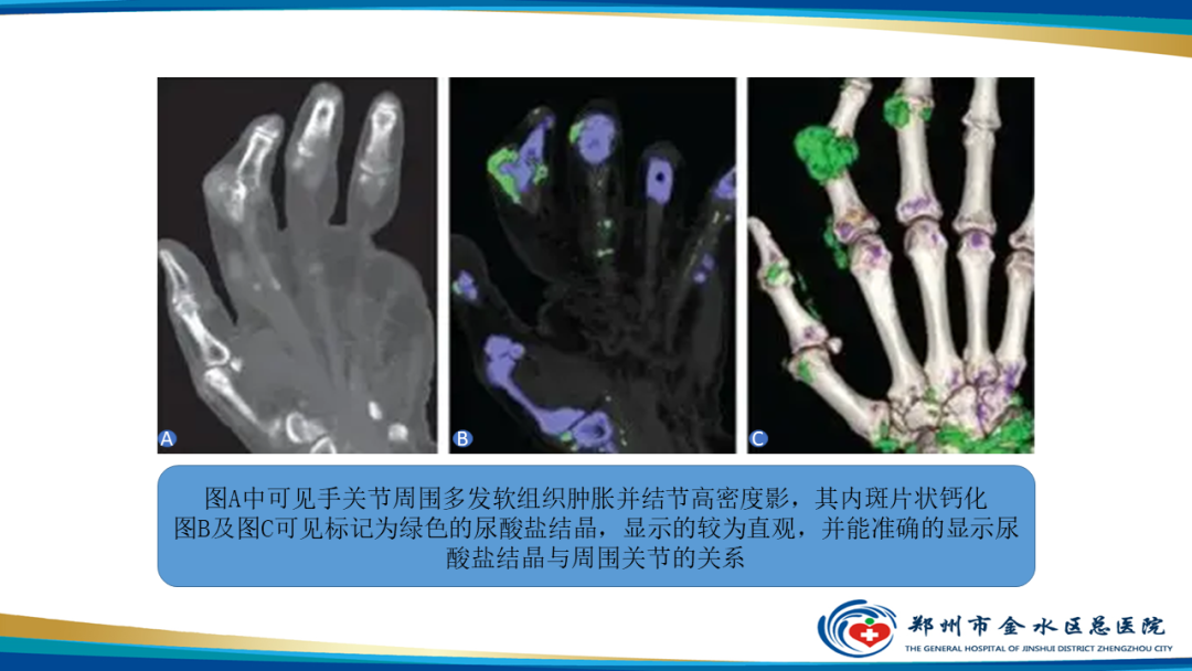 【PPT】痛风的影像诊断及鉴别诊断-16