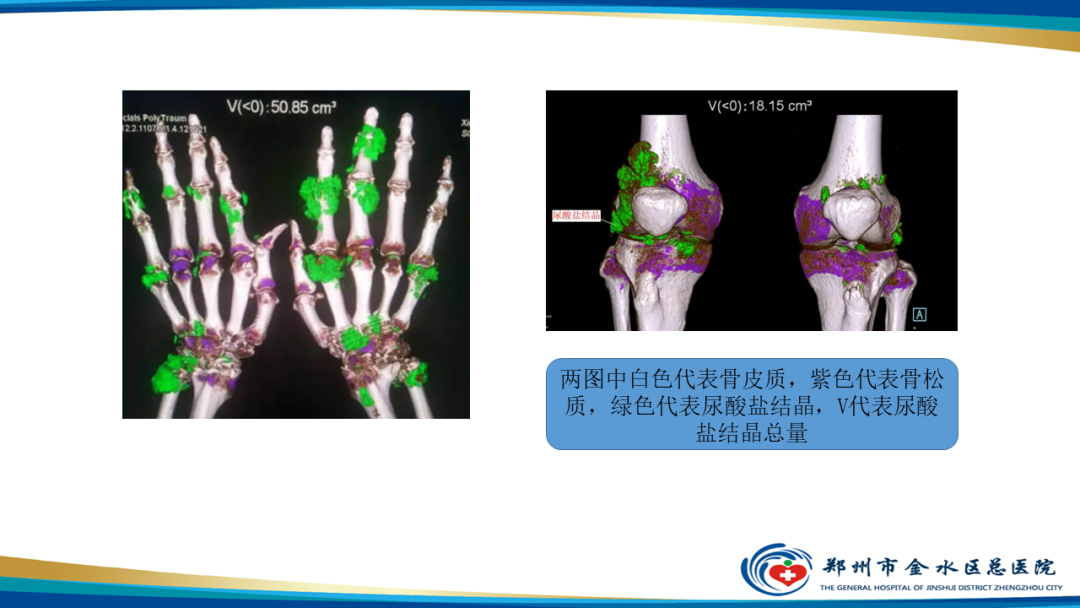 【PPT】痛风的影像诊断及鉴别诊断-17