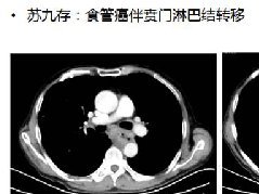 CT在食管癌诊疗中的应用
