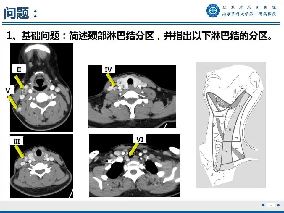 【PPT】甲状腺乳头状癌颈部淋巴结转移-11