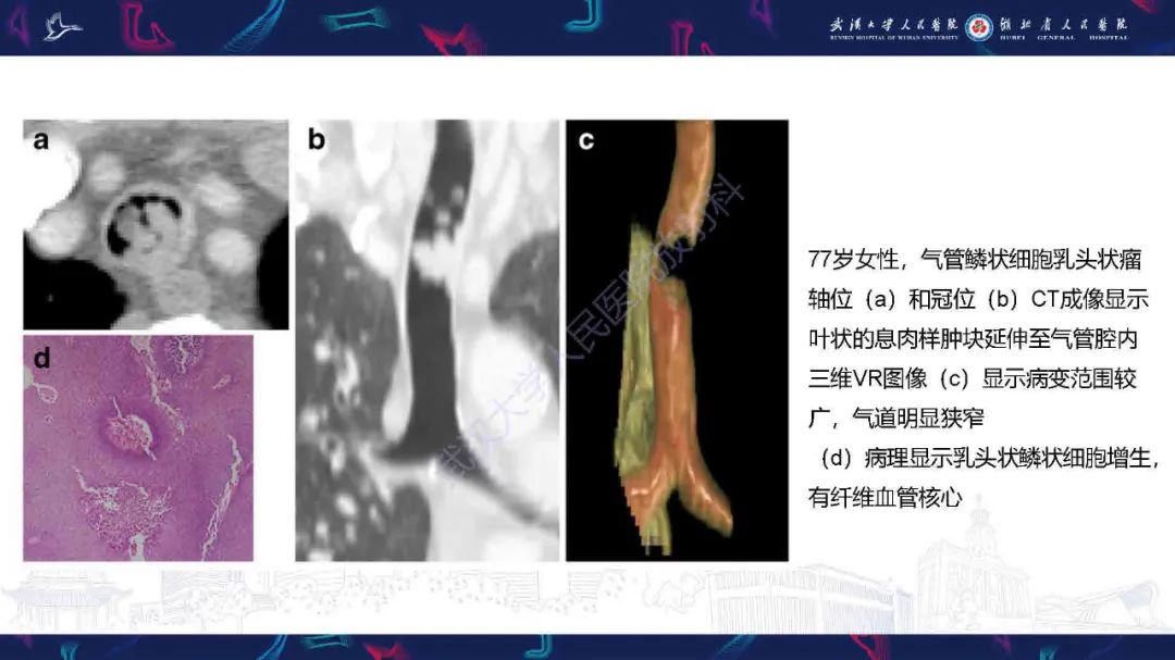 【PPT】成人气管支气管病变影像诊断-8