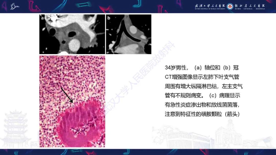 【PPT】成人气管支气管病变影像诊断-25