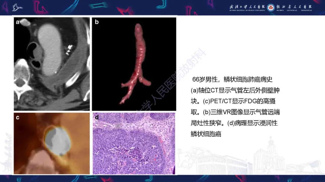 【PPT】成人气管支气管病变影像诊断-37