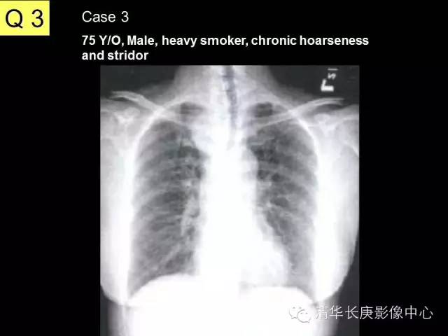【病例】胸内甲状腺肿1例CT影像表现